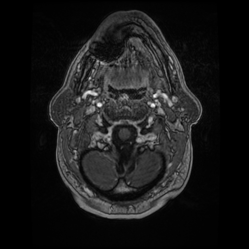 File:Cerebellar metastasis of pulmonary adenocarcinoma, cavernous venous malformation, and developmental venous anomaly (Radiopaedia 85827-101661 Axial T1 C+ 12).jpg