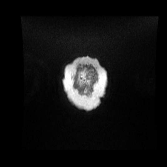 Cerebellar metastasis of pulmonary adenocarcinoma, cavernous venous malformation, and developmental venous anomaly (Radiopaedia 85827-101661 Coronal T1 C+ 6).jpg
