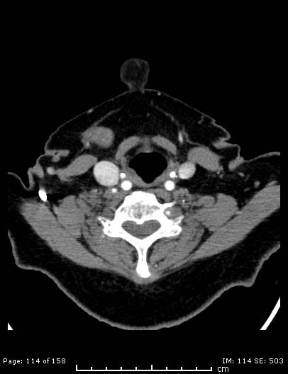File:Cerebellar strokes due to intracranial giant cell arteritis (Radiopaedia 68799-78510 CT angiogram 114).jpg