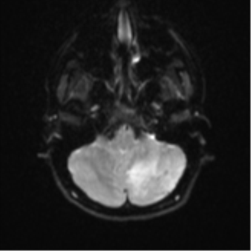 Cerebellar tuberculomas (Radiopaedia 46939-51472 Axial DWI 6).png