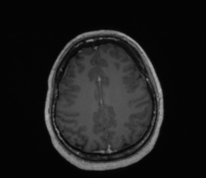 Cerebellopontine angle meningioma (Radiopaedia 35181-36715 Axial T1 C+ 18).jpg
