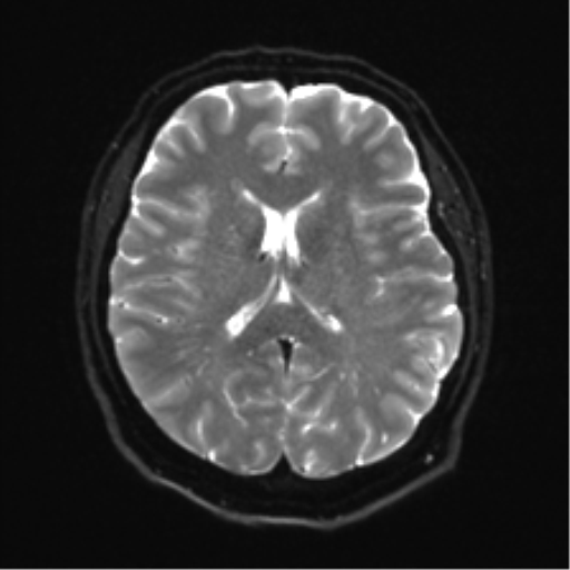Cerebellopontine angle meningioma (Radiopaedia 48434-53348 Axial DWI 23).png