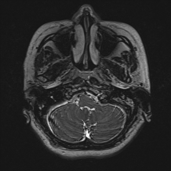 Cerebellopontine angle meningioma (Radiopaedia 53561-59591 Axial 3D volume T2 29).jpg