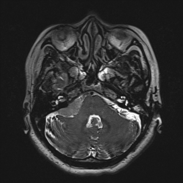 Cerebellopontine angle meningioma (Radiopaedia 53561-59591 Axial 3D volume T2 54).jpg