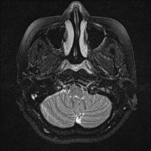 File:Cerebellopontine angle meningioma (Radiopaedia 53561-59591 Axial T2 fat sat 4).jpg