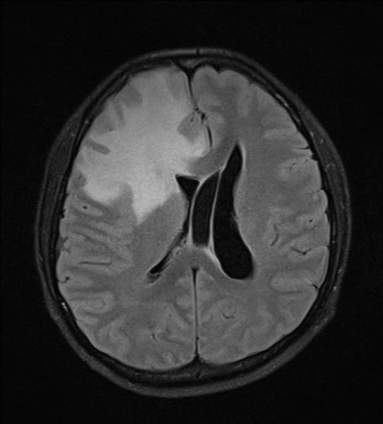 File:Cerebral abscess (Radiopaedia 24212-24478 Axial FLAIR 16).jpg