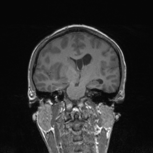 Cerebral abscess (Radiopaedia 24212-24478 Coronal T1 114).jpg