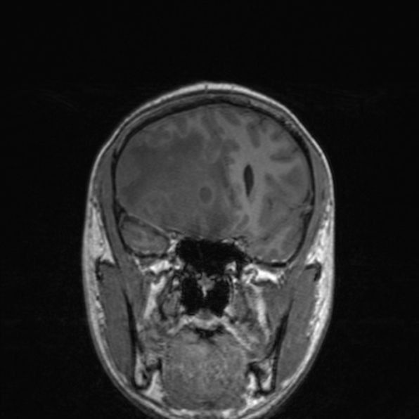 Cerebral abscess (Radiopaedia 24212-24478 Coronal T1 77).jpg