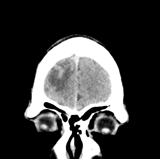 Cerebral abscess (Radiopaedia 60342-68008 Coronal non-contrast 7).png