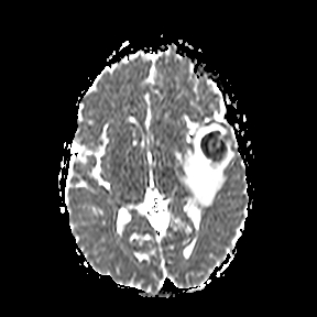 File:Cerebral abscess post cardiac surgery (Radiopaedia 27244-27420 Axial ADC 12).jpg