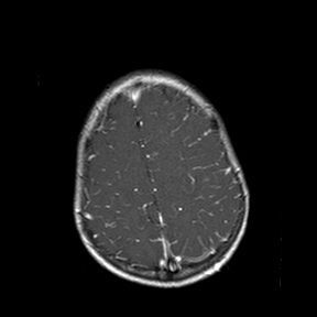 File:Cerebral abscess post cardiac surgery (Radiopaedia 27244-27420 Axial T1 C+ 18).jpg