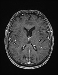 Cerebral amyloid angiopathy-related inflammation (Radiopaedia 58270-65377 Axial T1 C+ fat sat 82).jpg