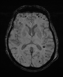 File:Cerebral amyloid angiopathy-related inflammation (Radiopaedia 74836-85849 Axial SWI 39).jpg