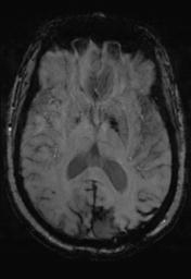 File:Cerebral amyloid angiopathy (Radiopaedia 29129-29518 Axial SWI MPR 19).jpg