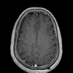 Cerebral amyloid angiopathy (Radiopaedia 29129-29518 Axial T1 C+ 104).jpg