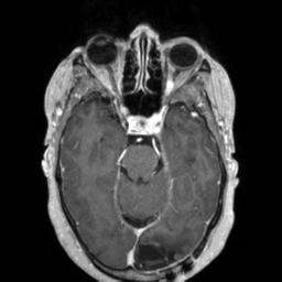 Cerebral amyloid angiopathy (Radiopaedia 29129-29518 Axial T1 C+ 55).jpg