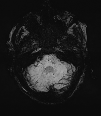 File:Cerebral amyloid angiopathy (Radiopaedia 46082-50433 Axial SWI MIP 16).png