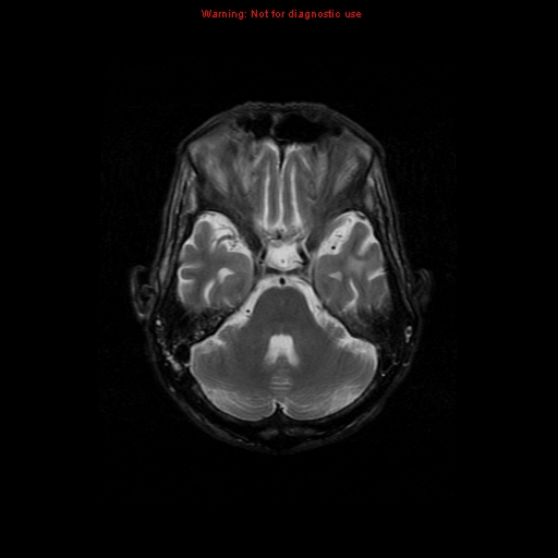 File:Cerebral and orbital tuberculomas (Radiopaedia 13308-13311 Axial T2 7).jpg
