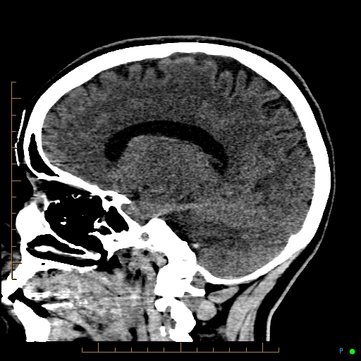 File:Cerebral arteriovenous malformation (AVM) (Radiopaedia 78162-90706 A 47).jpg