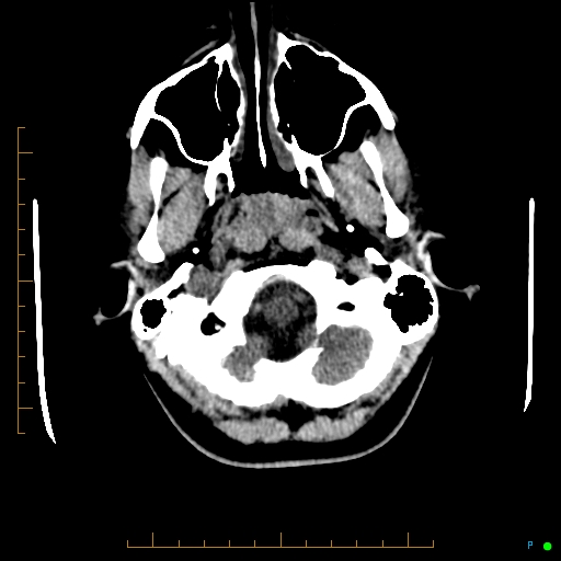Cerebral arteriovenous malformation (AVM) (Radiopaedia 78162-90706 Axial non-contrast 9).jpg