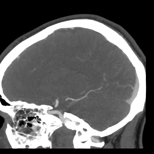 File:Cerebral arteriovenous malformation (Radiopaedia 39259-41505 Sagittal 37).png