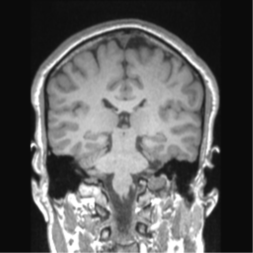 Cerebral arteriovenous malformation (Radiopaedia 39259-41506 Coronal T1 40).png