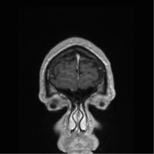 Cerebral arteriovenous malformation (Radiopaedia 39259-41506 Coronal T1 C+ 88).png