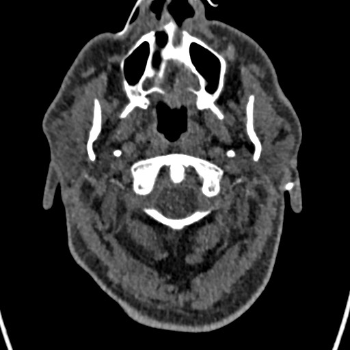 File:Cerebral arteriovenous malformation (Radiopaedia 78188-90746 Axial non-contrast 5).jpg