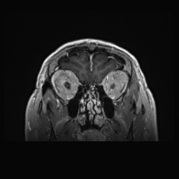 Cerebral arteriovenous malformation (Radiopaedia 84015-99245 Coronal T1 C+ 30).jpg