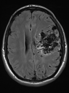 File:Cerebral arteriovenous malformation - huge (Radiopaedia 35734-37272 Axial FLAIR 15).png