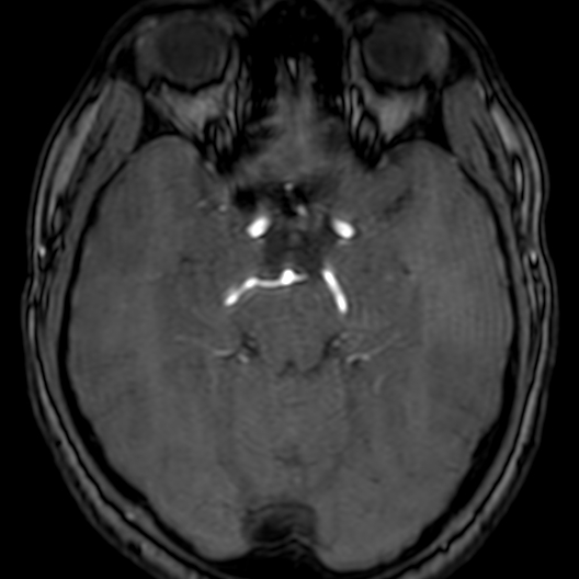 Cerebral arteriovenous malformation at posterior body of corpus callosum (Radiopaedia 74111-84925 Axial MRA 74).jpg