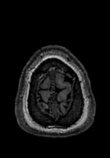 Cerebral arteriovenous malformation at posterior body of corpus callosum (Radiopaedia 74111-84925 Axial T1 1).jpg