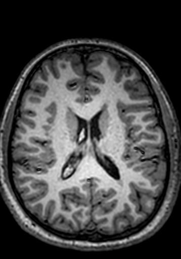 Cerebral arteriovenous malformation at posterior body of corpus callosum (Radiopaedia 74111-84925 Axial T1 116).jpg