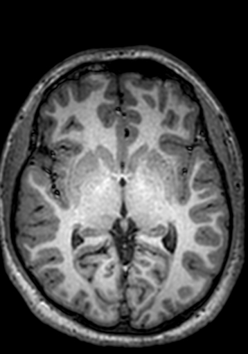 Cerebral arteriovenous malformation at posterior body of corpus callosum (Radiopaedia 74111-84925 Axial T1 155).jpg