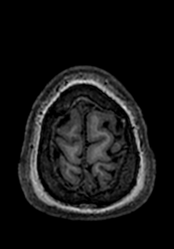 Cerebral arteriovenous malformation at posterior body of corpus callosum (Radiopaedia 74111-84925 Axial T1 9).jpg