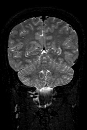Cerebral arteriovenous malformation at posterior body of corpus callosum (Radiopaedia 74111-84925 Coronal T2 130).jpg