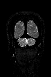Cerebral arteriovenous malformation at posterior body of corpus callosum (Radiopaedia 74111-84925 Coronal T2 166).jpg