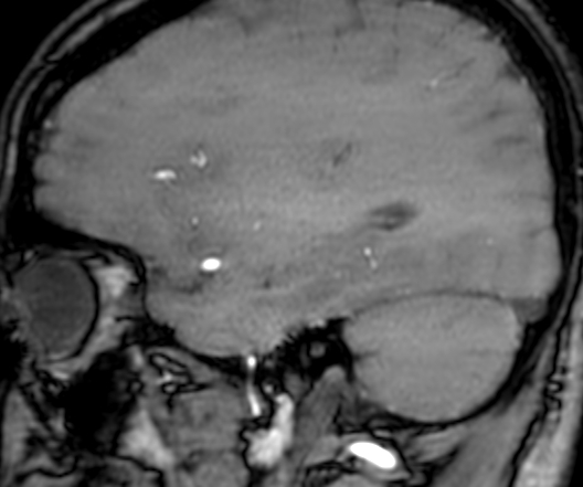 Cerebral arteriovenous malformation at posterior body of corpus callosum (Radiopaedia 74111-84925 J 291).jpg