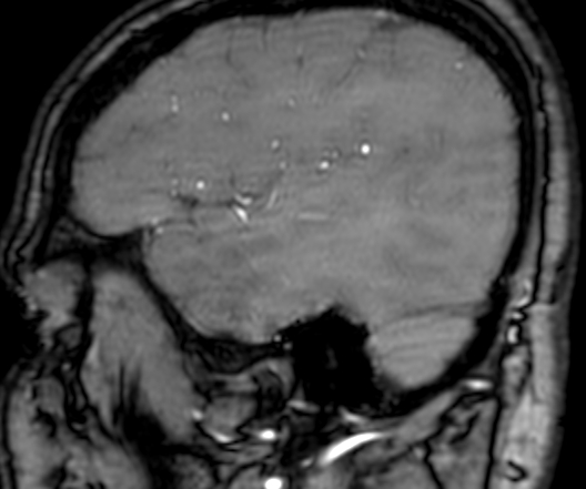 File:Cerebral arteriovenous malformation at posterior body of corpus callosum (Radiopaedia 74111-84925 J 57).jpg