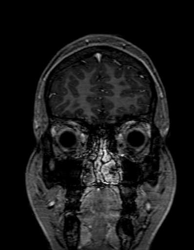 Cerebral arteriovenous malformation at posterior body of corpus callosum (Radiopaedia 74111-84925 K 45).jpg