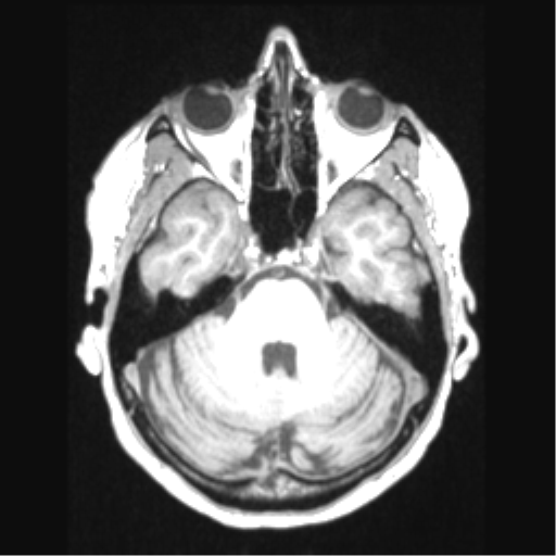 Cerebral arteriovenous malformation with hemorrhage (Radiopaedia 34422-35737 Axial T1 23).png