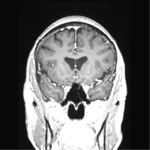 Cerebral arteriovenous malformation with hemorrhage (Radiopaedia 34422-35737 Coronal T1 C+ 61).png