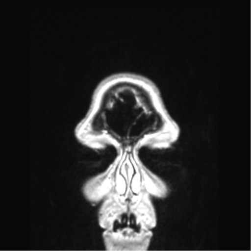 Cerebral arteriovenous malformation with hemorrhage (Radiopaedia 34422-35737 Coronal T1 C+ 90).png