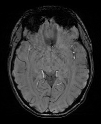 Cerebral cavernous venous malformation (Radiopaedia 70008-80021 I 33).jpg