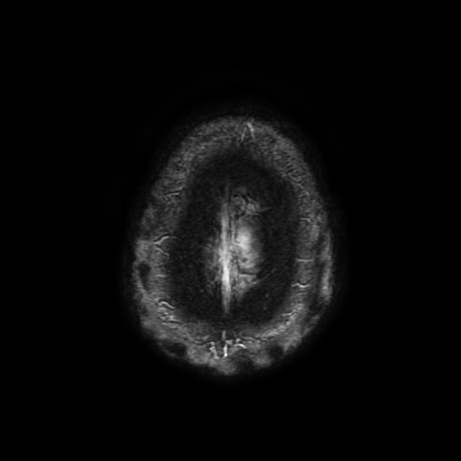 Cerebral cavernous venous malformation (Zabramski type II) (Radiopaedia 85511-101198 Axial SWI 112).jpg
