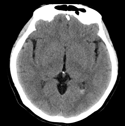 File:Cerebral cavernous venous malformations (Radiopaedia 48117-52945 Axial non-contrast 16).png