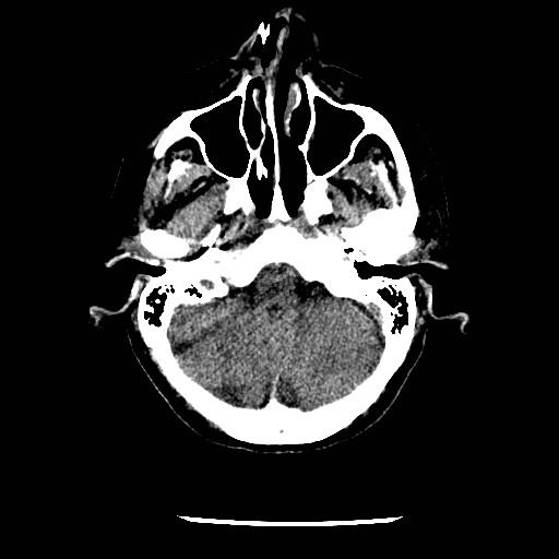 File:Cerebral edema (evolution in time) (Radiopaedia 19418-19441 non-contrast 20).jpg