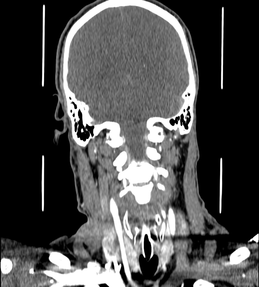 Cerebral edema in an overdose patient (Radiopaedia 72005-82539 B 100).jpg