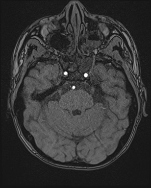 Cerebral embolic infarcts (embolic shower) (Radiopaedia 72391-82921 Axial MRA 37).jpg