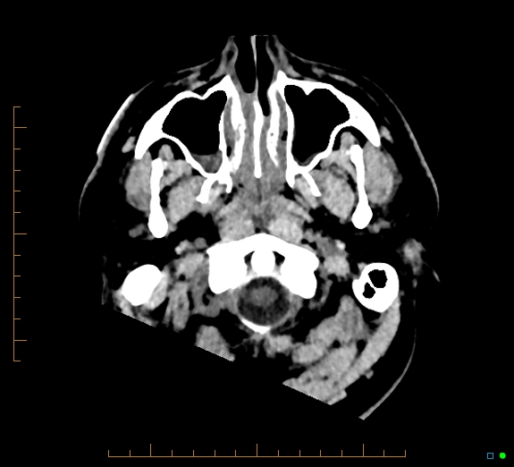 Cerebral fat embolism (Radiopaedia 85521-101224 Axial non-contrast 3).jpg